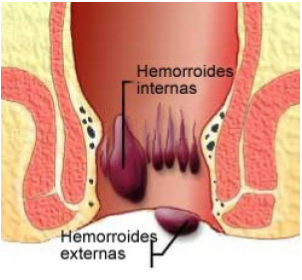 Sufro de Hemorroides, ¿hay solución?-Blog Farmacia La Estación